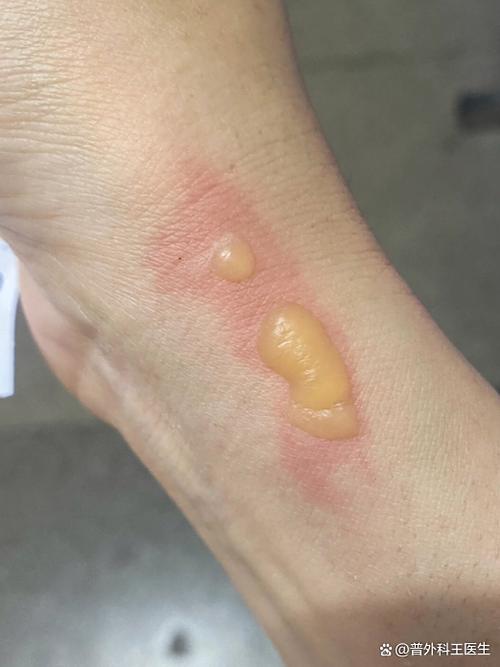烫伤抹什么好得快生活小妙招图标