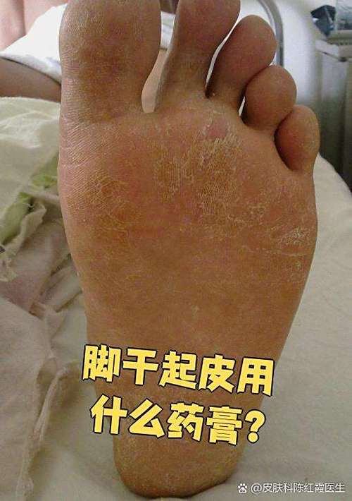脚底干裂起硬皮涂抹什么药缩略图