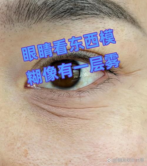 一只眼睛突然模糊看不清像有层雾缩略图