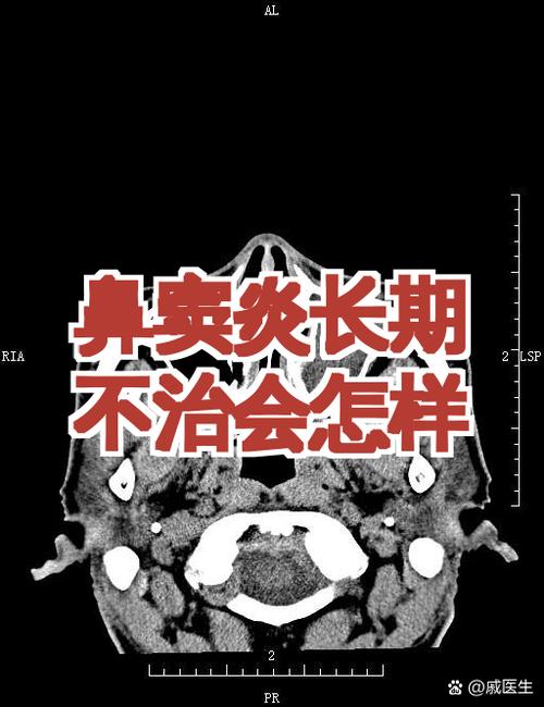 鼻窦炎长期不治会怎样图标