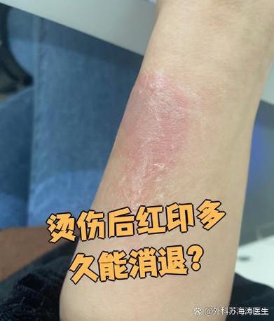 烫伤红印去除小妙招缩略图