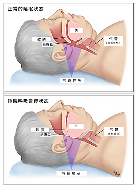 睡眠呼吸暂停综合征能治愈吗图标