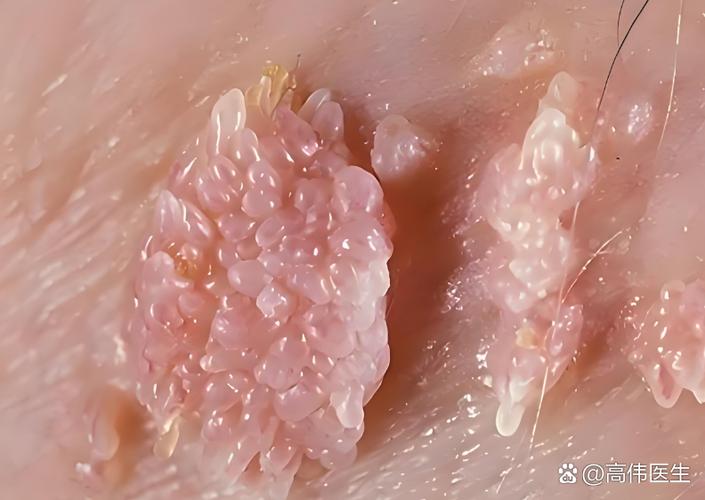 有hpv病毒但未感染是什么意思缩略图