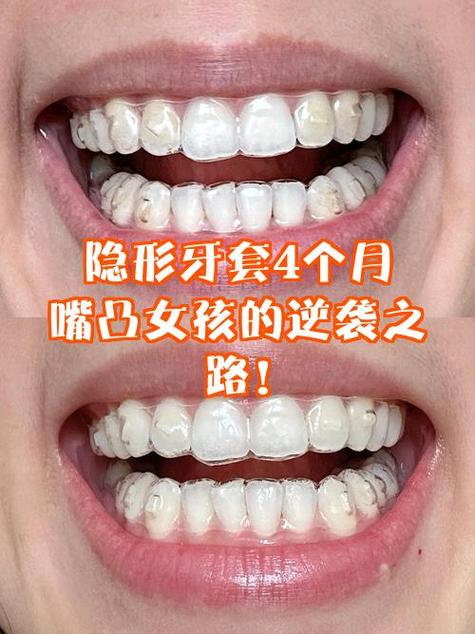 隐形牙套多少钱一副缩略图