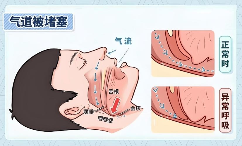 睡眠呼吸暂停会死人吗游戏截图