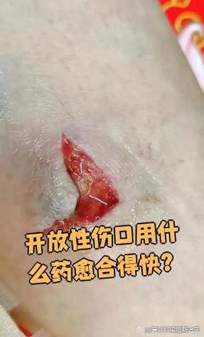 划伤了用什么药好得快缩略图