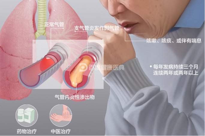 慢性支气管炎会自愈吗缩略图