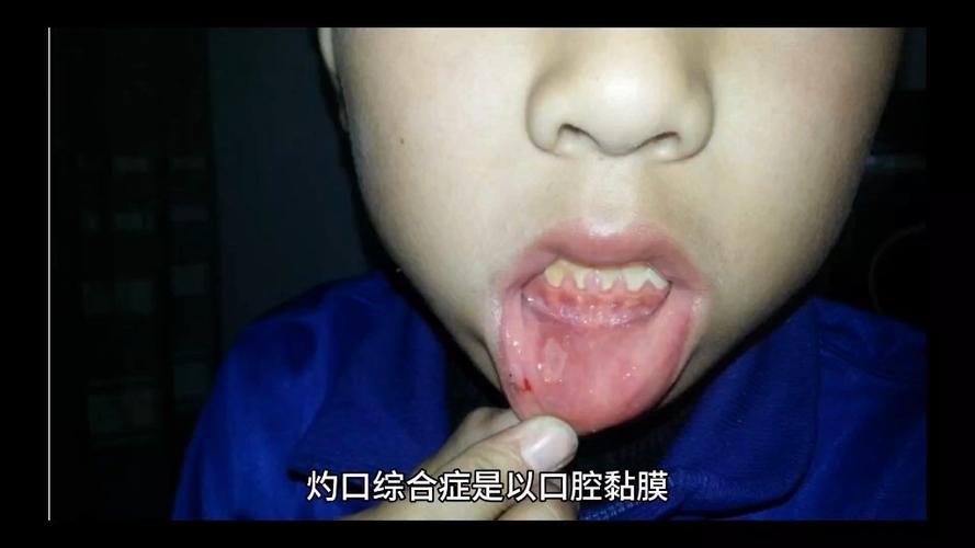 灼口综合症有哪些症状图标