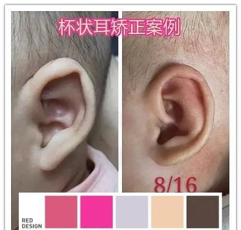 耳朵畸形矫正手术多少钱缩略图