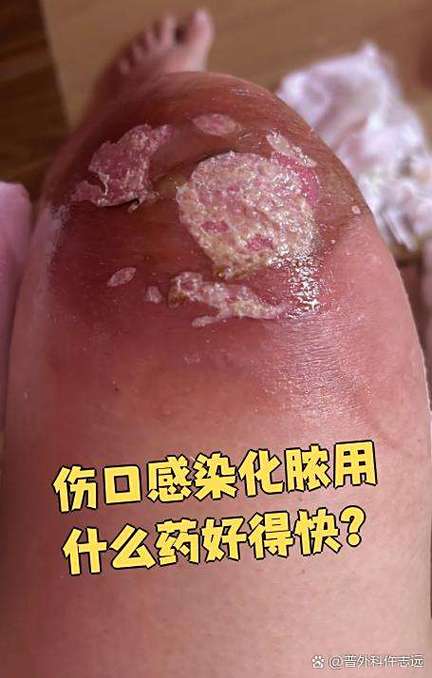 烫伤化脓了用什么药好得快缩略图