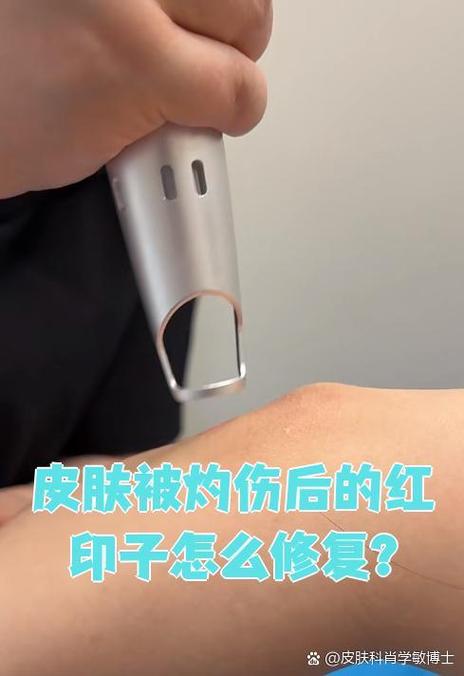 烫伤红印怎样去除缩略图