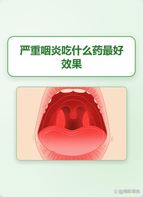咽喉炎吃什么药最好得快能根治缩略图