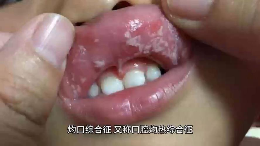 口灼综合症的最佳治疗方法缩略图