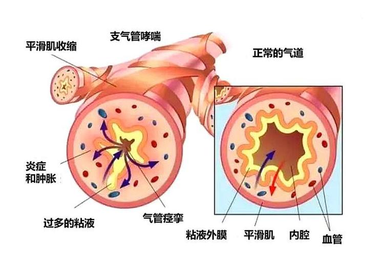 支气管炎哮喘如何根治缩略图