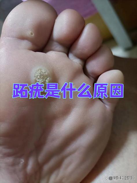 脚病毒感染怎么治疗缩略图