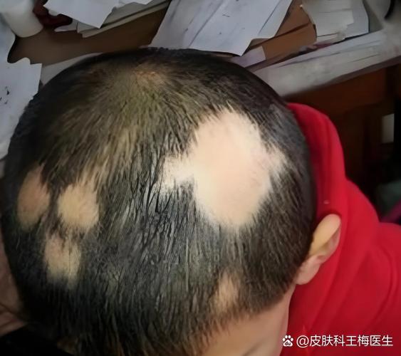 头上秃了一小块是怎么回事缩略图