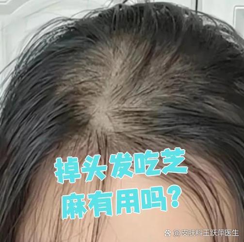 脱发吃芝麻有用吗缩略图