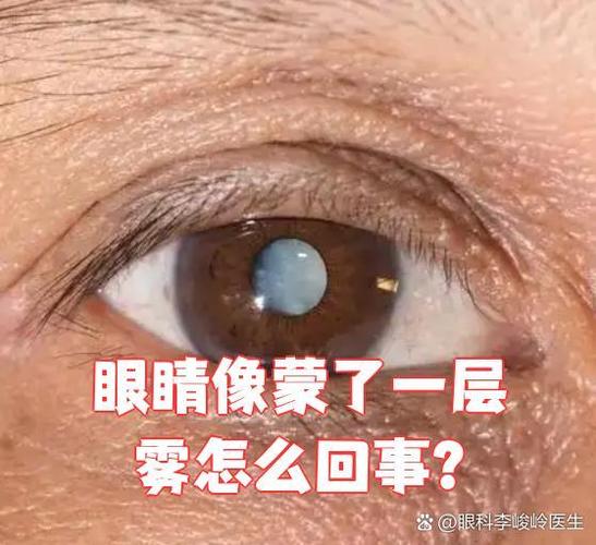 左眼模糊看不清像蒙了一层雾缩略图