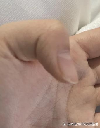 大拇指和食指时不时的抖是什么原因缩略图